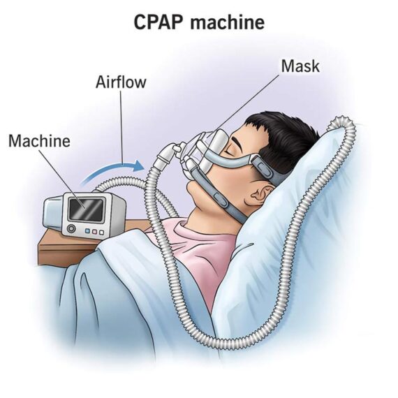 CPAP-Machine-on-Rent-des